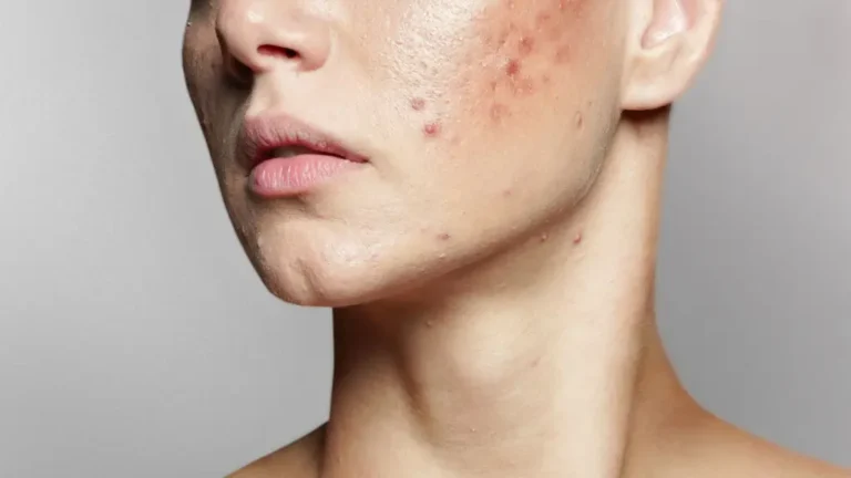 Say Goodbye to Acne Scars – The Ultimate Solution!