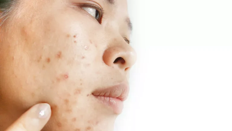 Tips Menghindari Kesalahan Memakai Skincare agar Kulit Bebas Jerawat