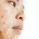 Tips Menghindari Kesalahan Memakai Skincare agar Kulit Bebas Jerawat