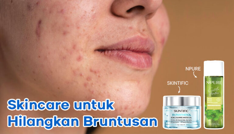 Tips Skincare Ampuh untuk Mengatasi Bruntusan di Pipi!